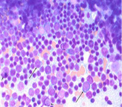Cytology 1 FNA from a thymoma in a dog (not the patient in this case). Nucleated cells consist predominantly of small lymphocytes. Low numbers of intermediate to large lymphocytes (long arrows) and occasional individual mast cells (short arrows) are also observed.