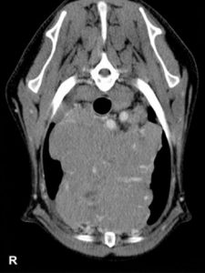 Figure 2 Transverse postcontrast CT image of the mediastinal mass.
